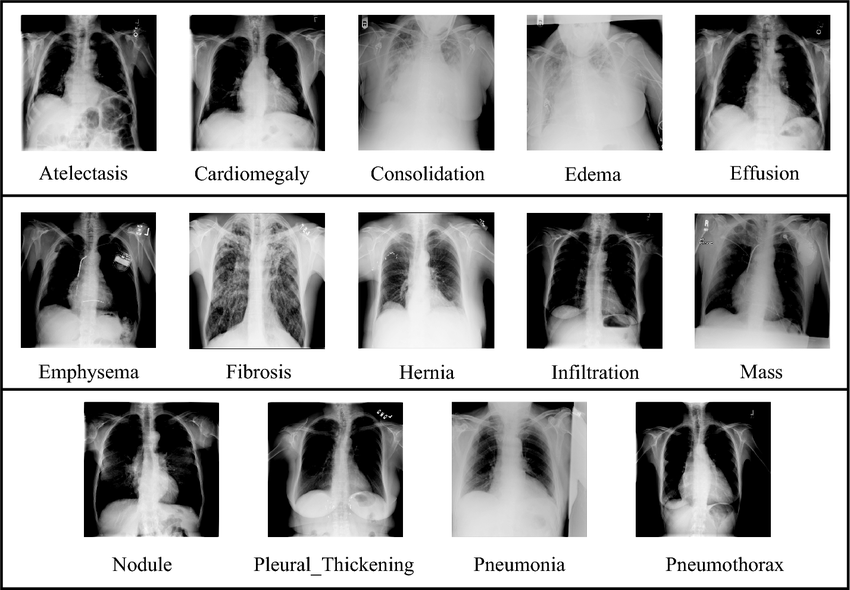 NIH Chest X-ray dataset, sample per disease